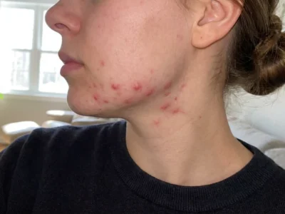 ਕੀ ਤੁਸੀਂ ਜਬਾੜੇ ਦੇ ਮੁਹਾਸੇ ਤੋਂ ਪਰੇਸ਼ਾਨ ਹੋ? ਇਹ ਸਪੈਸ਼ਲ ਡੀਟੌਕਸ ਡਰਿੰਕ 7 ਦਿਨਾਂ 'ਚ ਚਮੜੀ ਨੂੰ ਬਿਲਕੁਲ ਸਾਫ ਕਰੇਗਾ