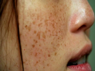 ਹੈਲਥ ਟਿਪਸ: ਤੁਹਾਡੀ ਚਮੜੀ ਦੇ ਰਹੀ ਹੈ 5 ਗੰਭੀਰ ਬੀਮਾਰੀਆਂ ਦੀ ਚੇਤਾਵਨੀ, ਗਲਤੀ ਨਾਲ ਵੀ ਇਨ੍ਹਾਂ ਲੱਛਣਾਂ ਨੂੰ ਨਜ਼ਰਅੰਦਾਜ਼ ਨਾ ਕਰੋ